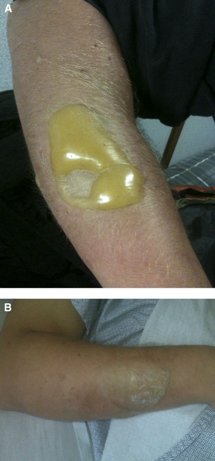 dermal injury due to sulfur mustard
