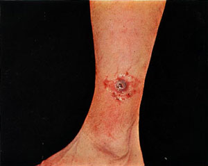 leg lesion caused by tularemia