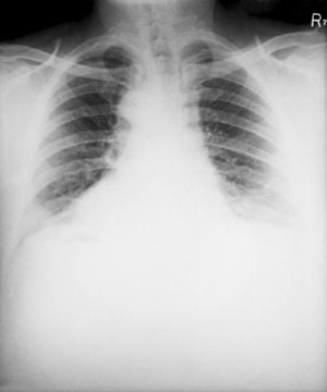 X-ray of a patient with inhalational anthrax showing bilateral effusion and widening of the mediastinum