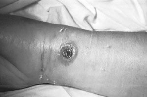 A patient with a cutaneous anthrax lesion on the arm. 