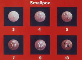 WHO smallpox slide